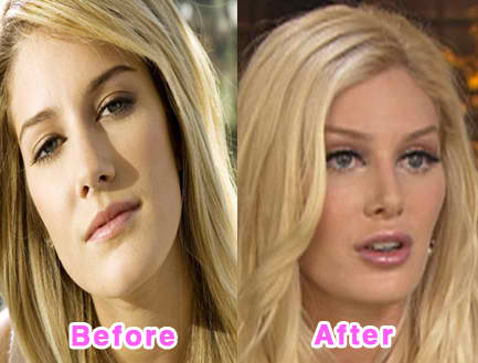 heidi montag surgery before after. Heidi Montag