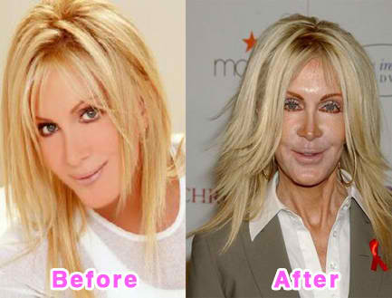 Joan Van Ark before and after cosmetic enhancements image hosted by http 